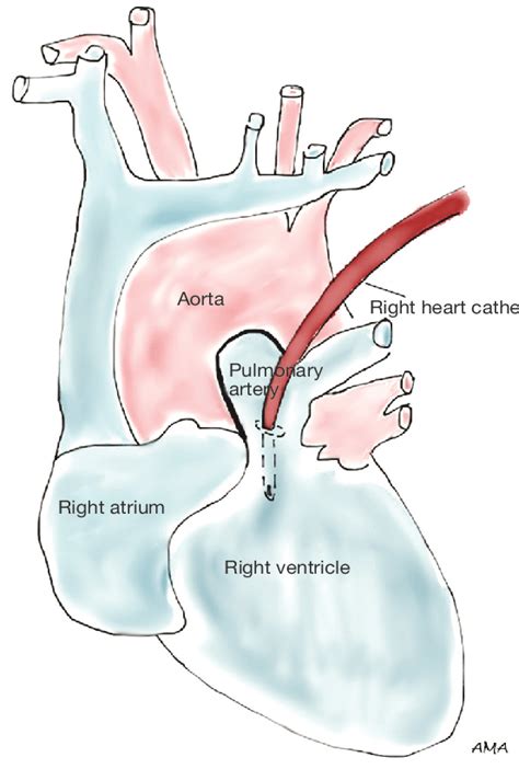 partial left heart bypass